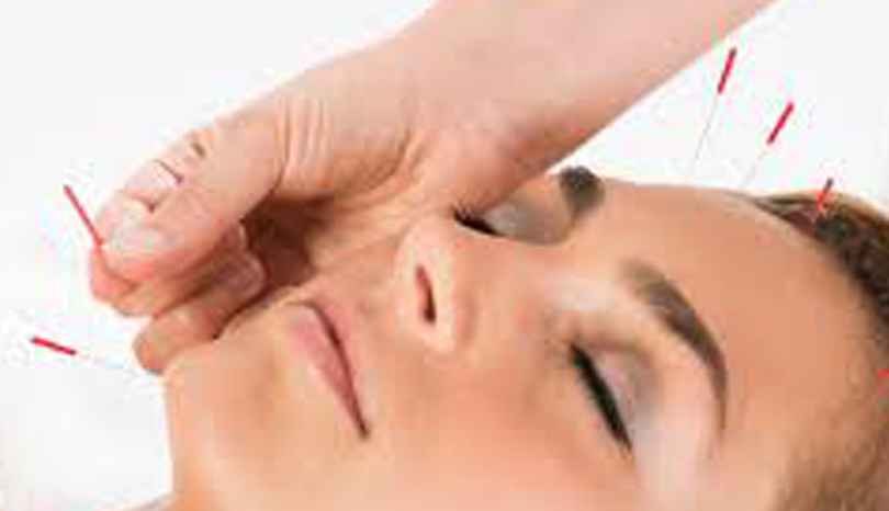 Acupuntura para queda dos Cabelos