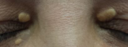 Cirurgia do Xantelasma Palpebral