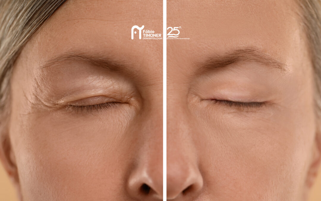 Imagem ilustrativa de uma antes e depois do procedimento de cirurgia das palpebras