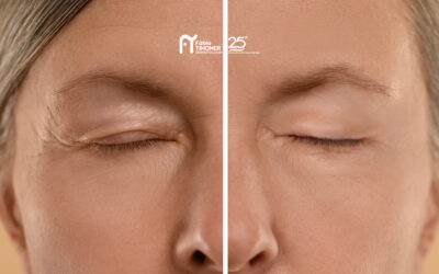 Blefaroplastia: cirurgia das pálpebras  