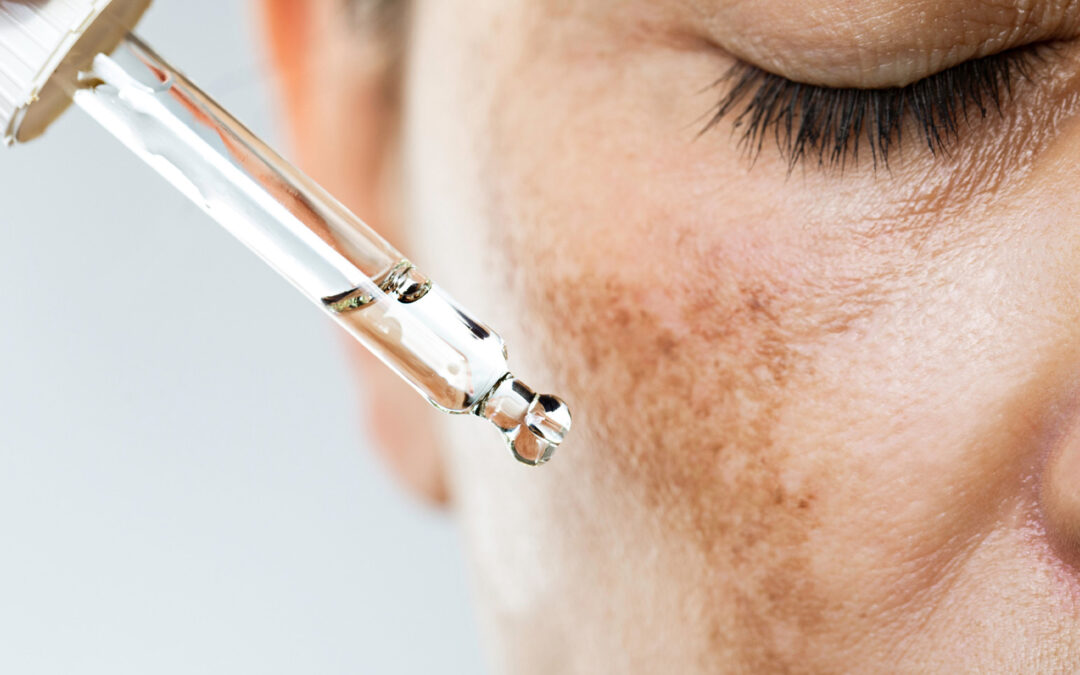Melasma tem cura