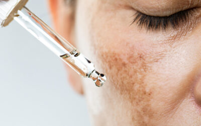 Melasma tem cura? Entenda as causas e os tratamentos mais eficientes